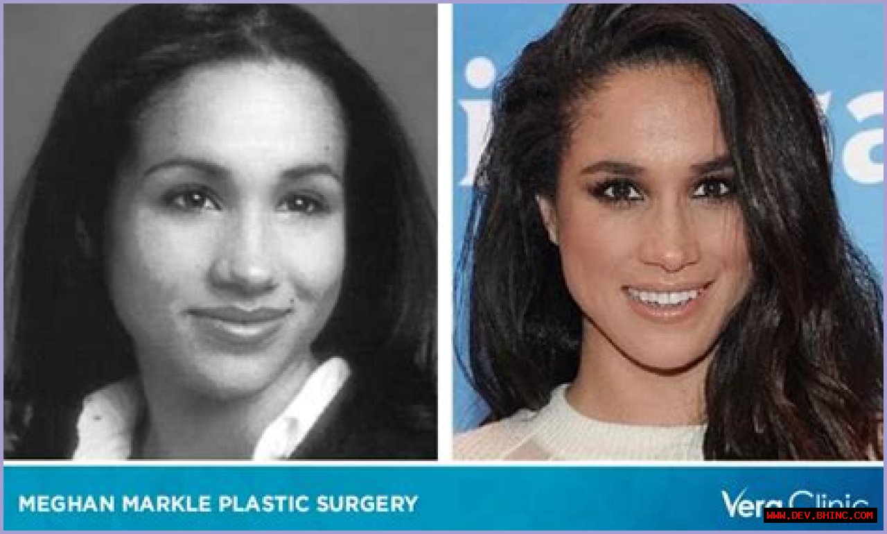 Did Meghan Markle Get Plastic Surgery? Inside Nose Job and Botox Rumors About the Duchess