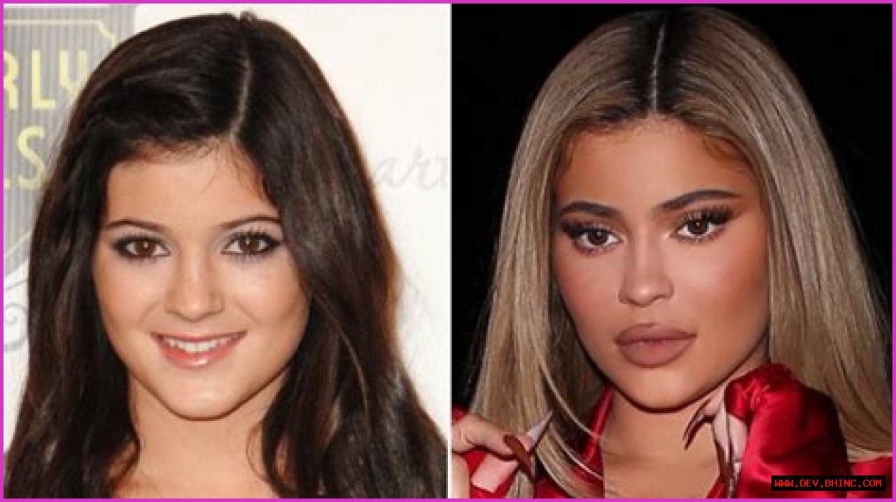 Kylie Jenner Is No Stranger to Plastic Surgery: Her Transformation Before and After Lip Fillers
